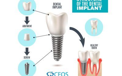 Qué son los implantes dentales: todo lo que necesitas saber